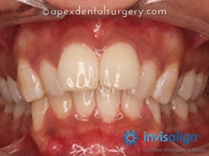 Case 7 before